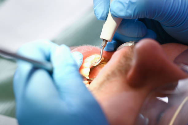 Best Emergency Root Canal Treatment in Madison, FL